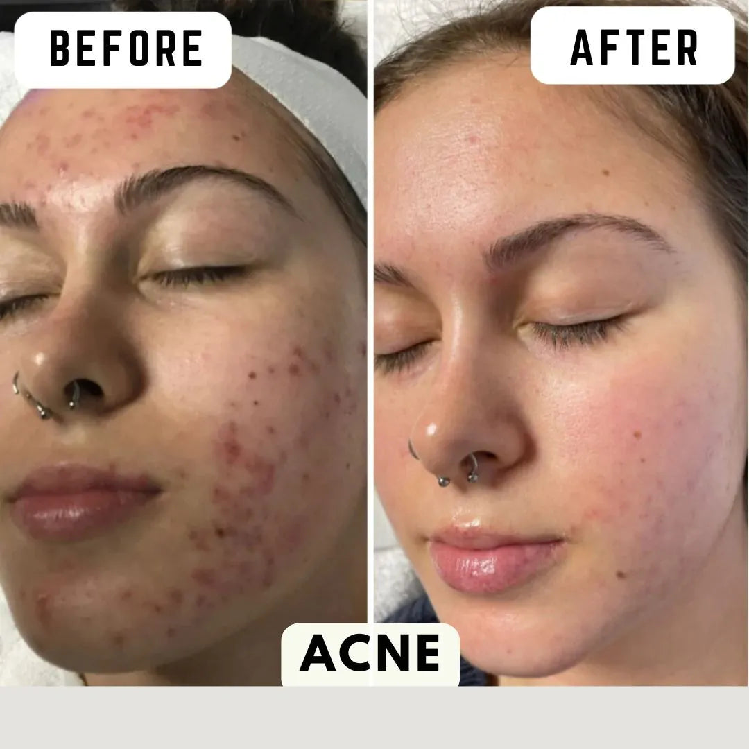 قناع العناية بالبشرة بالضوء | ضمان عام