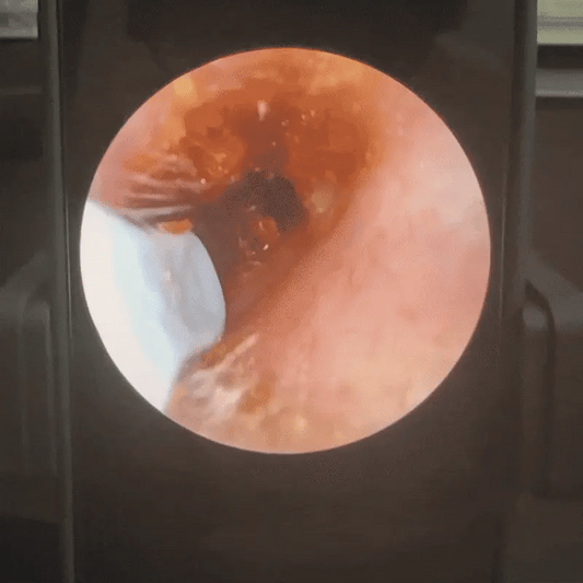 WaxClean™ – تنظيف الأذن الذكي